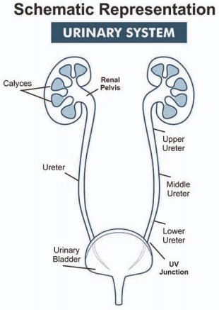 Small Kidney Stones Cause Severe Pain