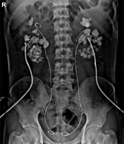 Kidney Stones