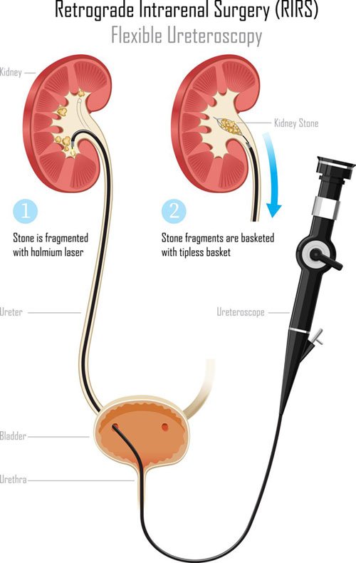 RIRS Surgery