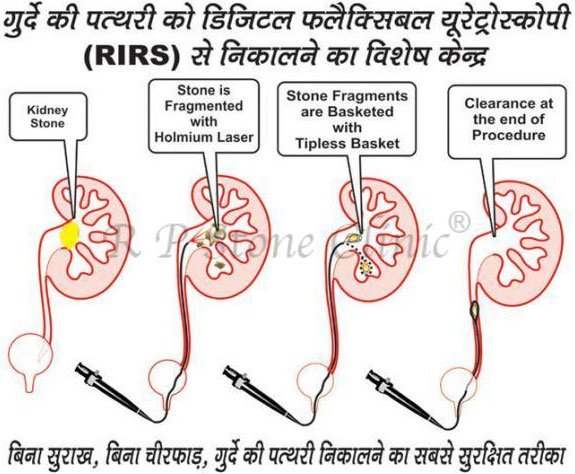 RIRS Surgery