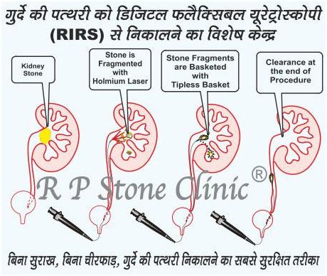 RIRS Surgery
