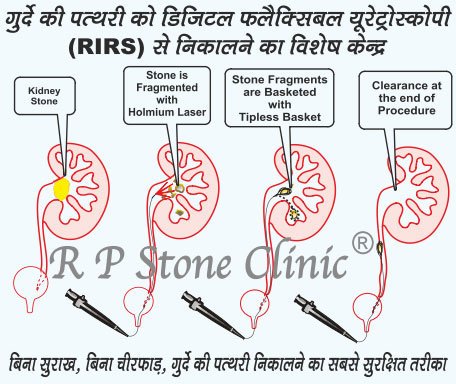 RIRS (Retrograde Intrarenal Surgery)